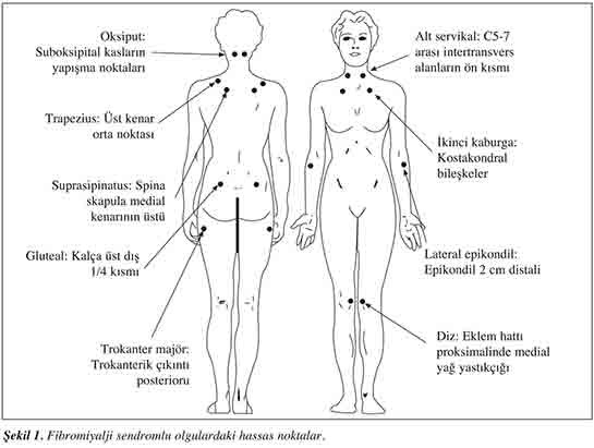 Fibromiyalji Hassas Noktalar