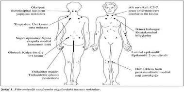 Fibromiyalji Hassas Noktalar